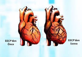 EECP Tedavisinden önce ve sonra kalp görüntüsü